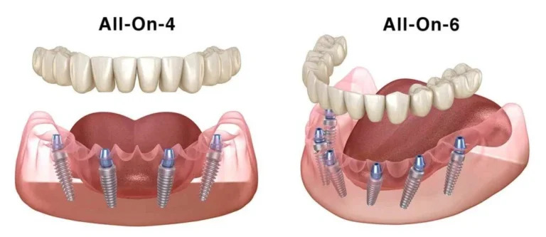 all-on-4-vs-all-on-6-dental-implants