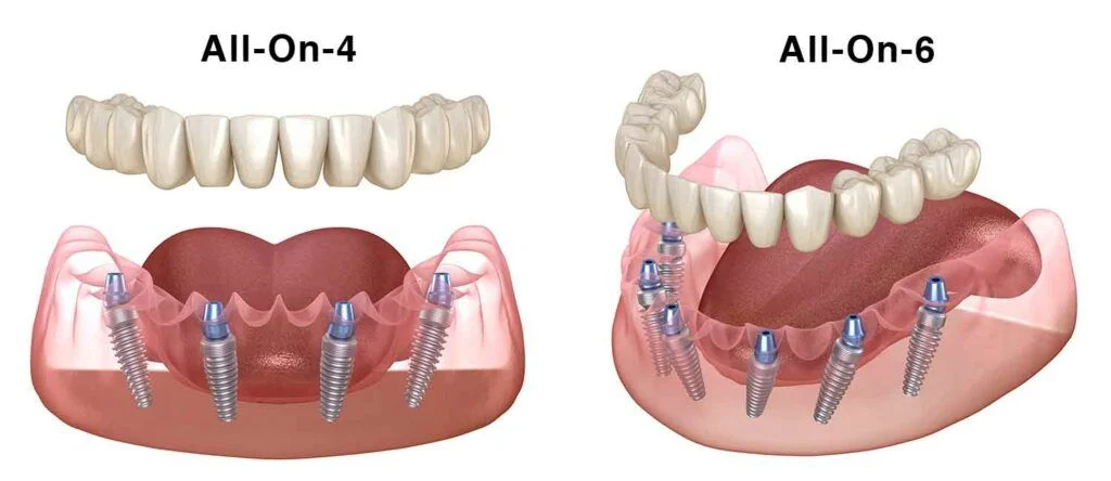 all-on-4-vs-all-on-6-dental-implants
