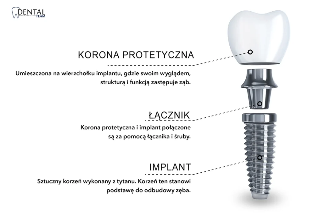 budowa implantu