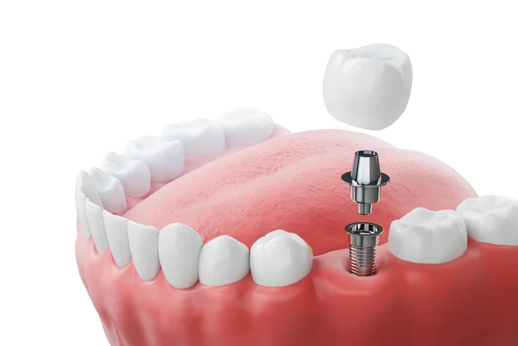 korona na implancie dental team