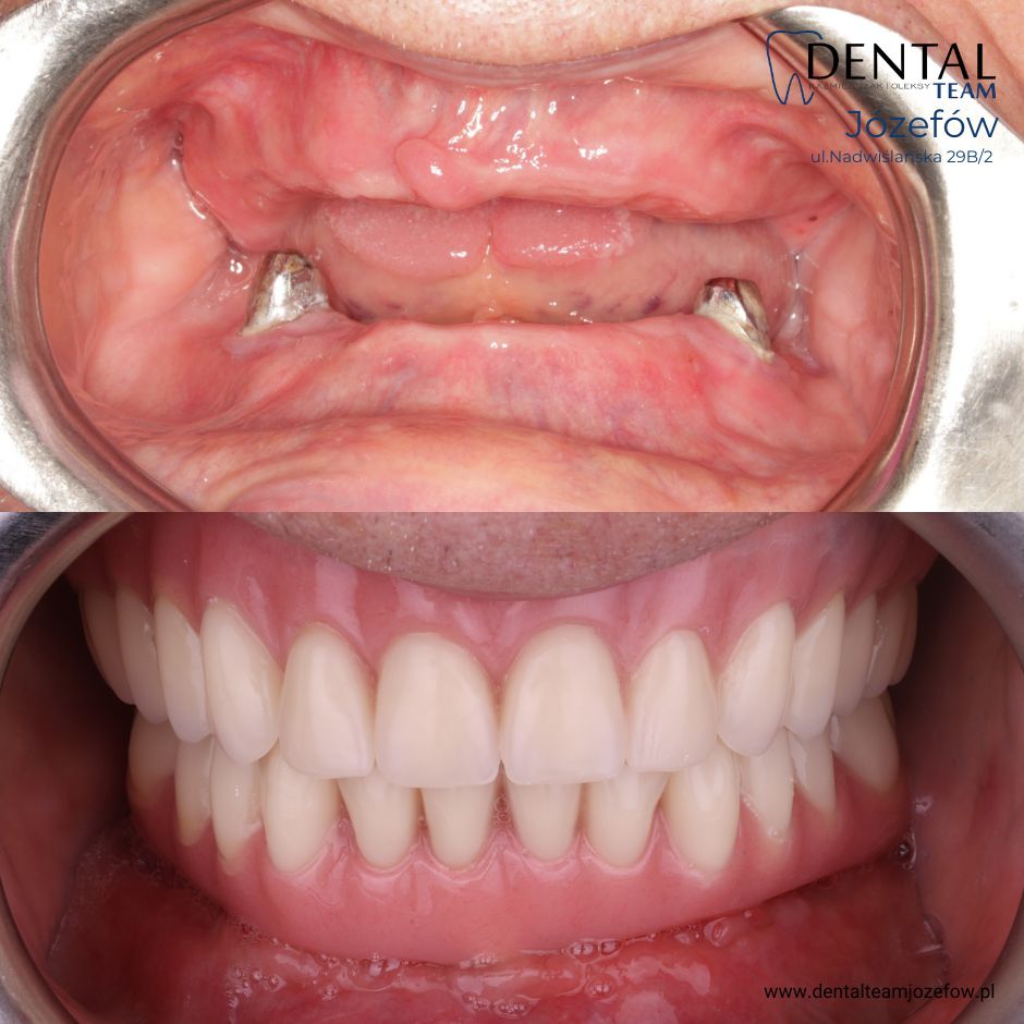 Odbudowa pełnołukowa DentalTeam All on 4 All on 6