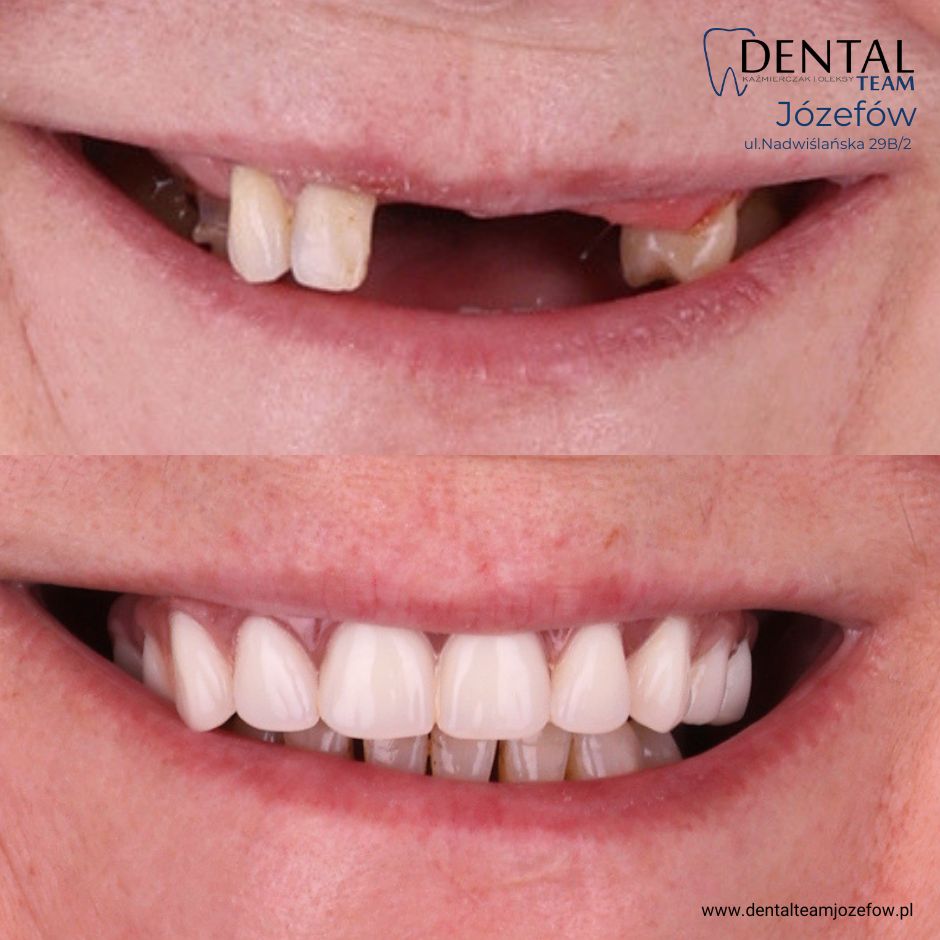 Odbudowa pełnołukowa DentalTeam All on 4 All on 6