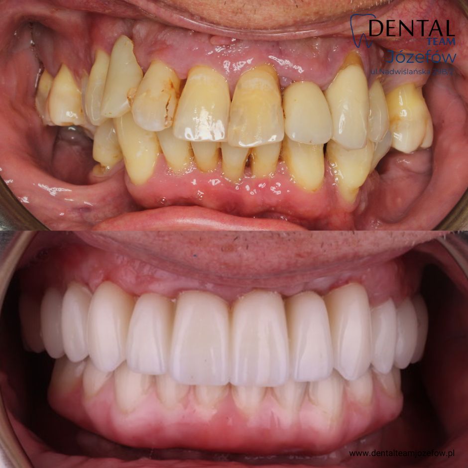Odbudowa pełnołukowa DentalTeam All on 4 All on 6